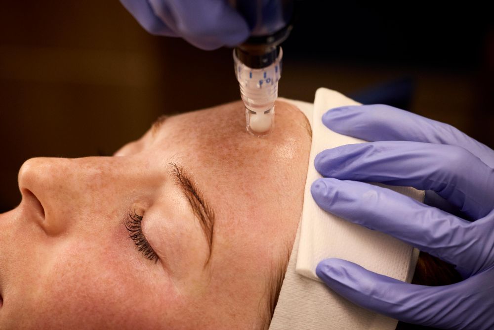 SkinPen treatment on forehead